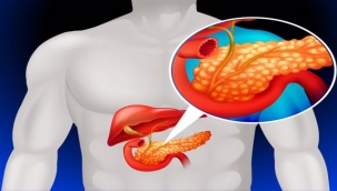 Pankreas Kanserinin Belirtileri Nelerdir?