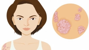 Sedef Hastalığı Işın Tedavisi Hangi Hastanelerde Yapılır?