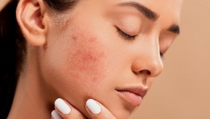 Gül Hastalığı Nedir? (Rosacea)