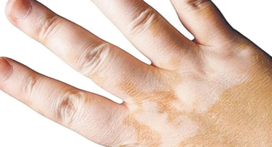 Addison Hastalığı Nedir?