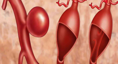 Anevrizma Nedir? Anevrizma Belirtileri