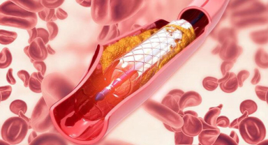 Anjiyo Nedir? Hangi Durumlarda Kullanılır?