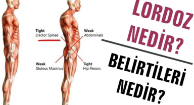 Hiperlordoz Nedir? Hiperlordoz Tedavisi Nasıl Yapılır?