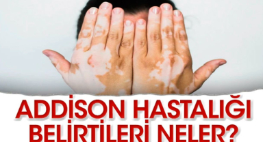 Addison Hastalığı Nedir? Addison Belirtileri Nelerdir?