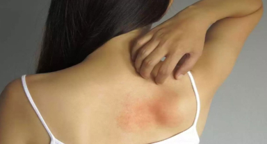 Histamin Nedir? Histamin Görevleri Nelerdir?