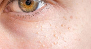 Komedon Nedir? Komedon Nasıl Oluşur? Önlemi Nedir?