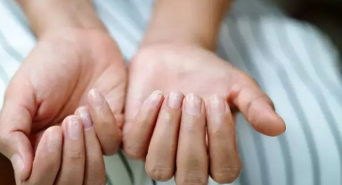 Makrodaktili Hastalığı Nedir? Makrodaktili Belirtileri Nedir?