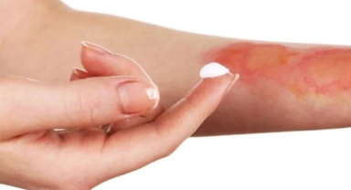 Yanık İzi Nasıl Geçer? Yanık İzi Tedavisinde Kullanılan Yöntemler Nelerdir?