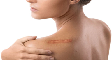 Yara İzi Nedir? Yara İzi Nasıl Geçer?